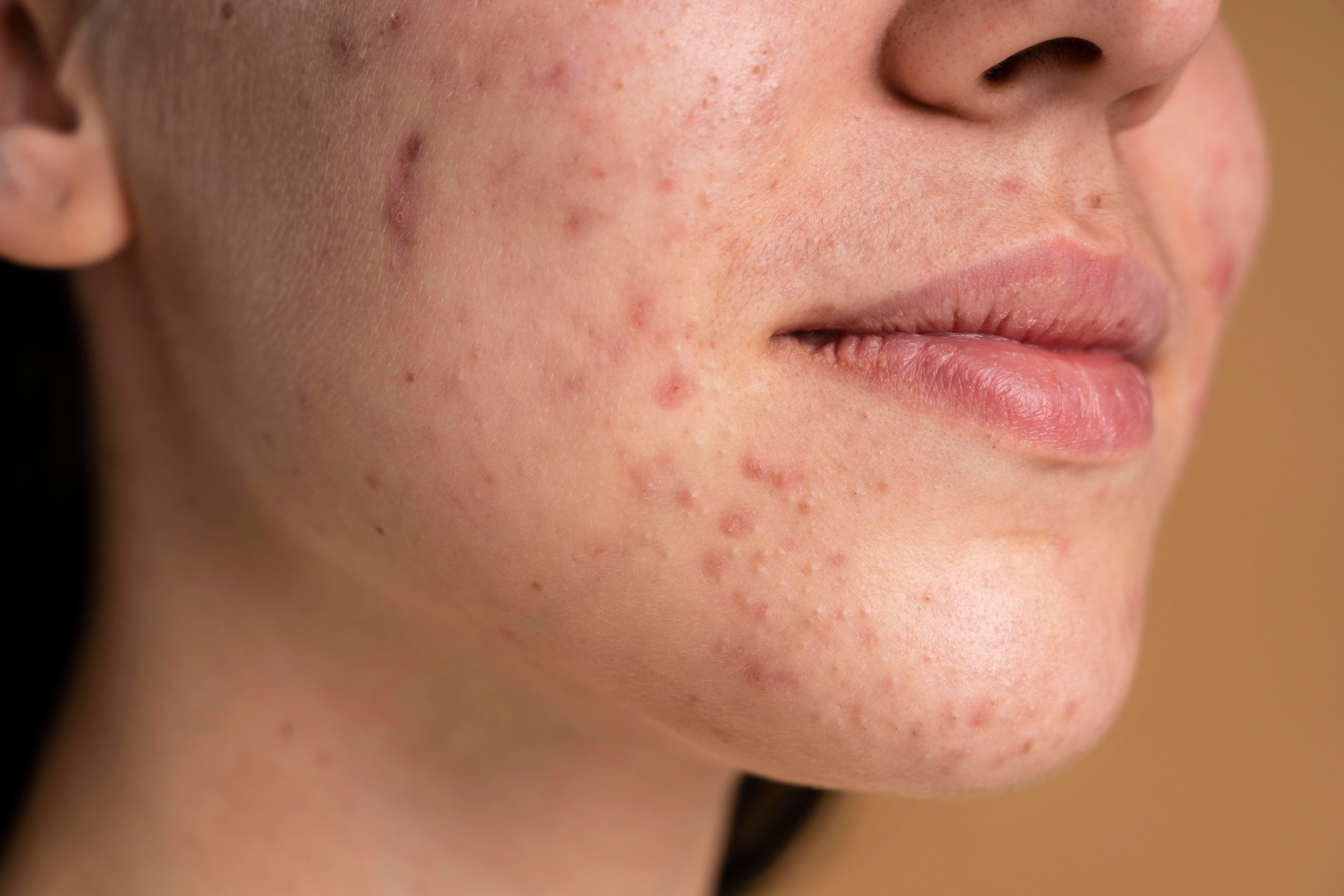 ACNE_NAME
