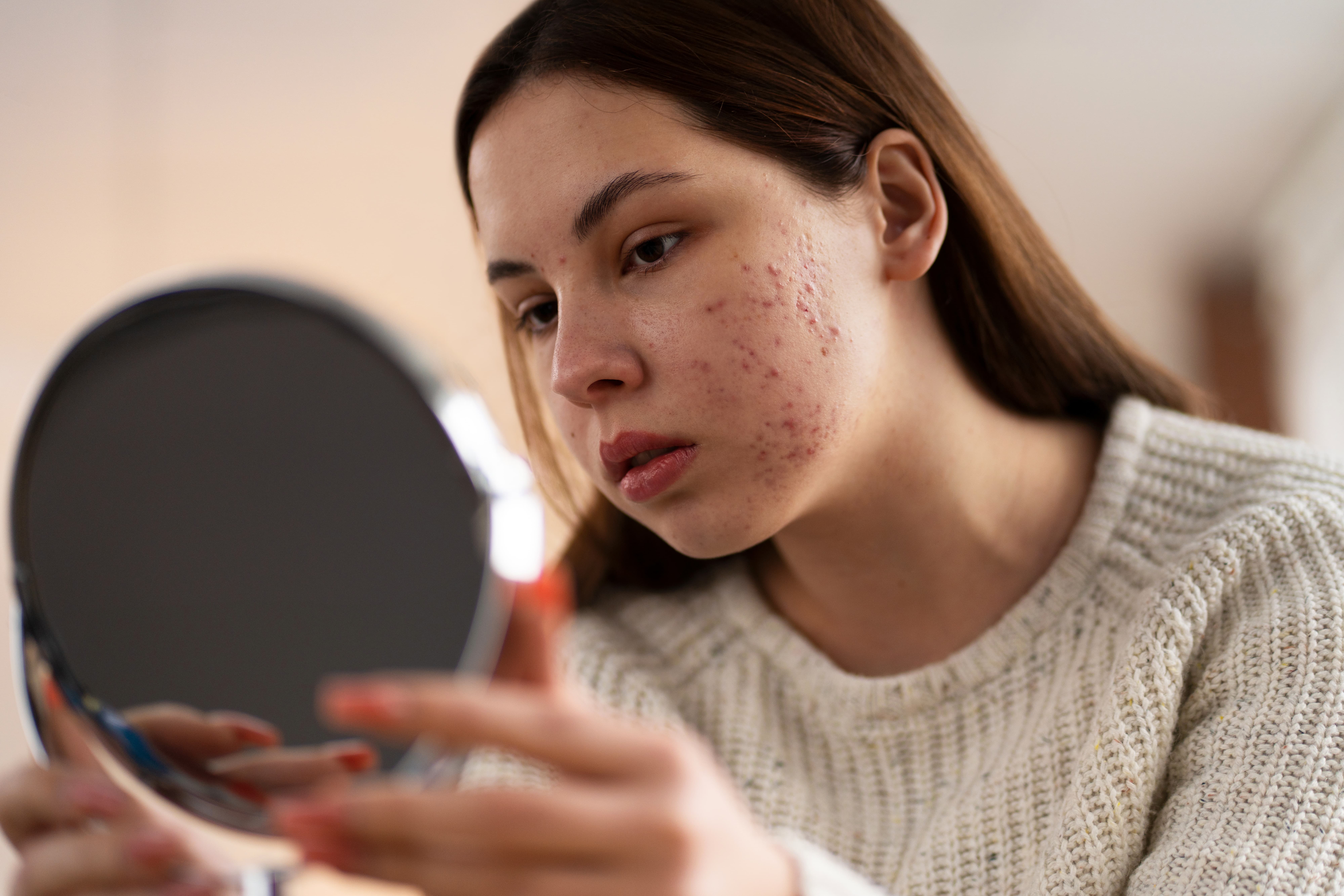 Acne behandeling